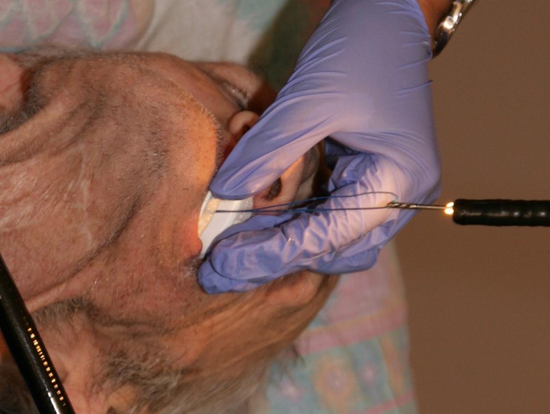 Wyprowadzenie endoskopu wraz z nicią poprzez usta pacjenta