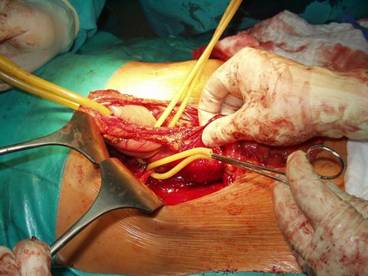 leczenie operacyjne stan przed pankreatoduodenektomią
