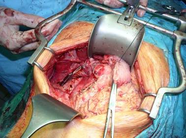leczenie operacyjne stan po pankreatoduodenektomii